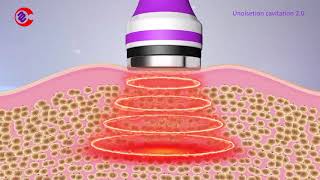 How Ultrasonic Cavitation Work How Ultrasonic Cavitation Remove Fat What Is Cavitation Machine [upl. by Leahkim]