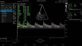 Doppler Transcraneal en adulto con el Hera w10 Elite sw v10303 [upl. by Akinuahs669]