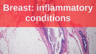 Breast Inflammatory Conditions  Pathology mini tutorial [upl. by Zicarelli]