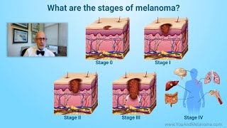 What are the stages of melanoma [upl. by Ramak]