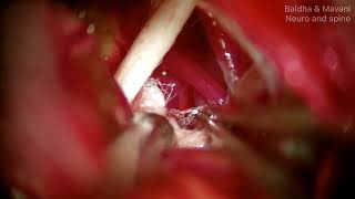 Hemifacial Spasm  Permanent Cure  MVDMicrovascular DecompressionFacial Nerve  Dr Mehul Baldha [upl. by Calen]