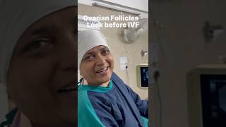 Ovarian Follicles  Look before IVF eggpick ovary fertility opudranshudrsuniljindal [upl. by Phyllida906]