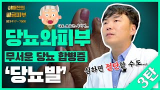 당뇨가 있었을때 가장 심각하고 주의를 요하는 피부질환  연세에이앤비 피부과 이해진원장 [upl. by Agnesse]