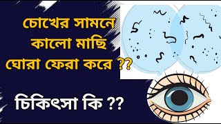 What are Floaters in eyes causes and treatment  Vitreous floaters eye eyefloaters eyeflashes [upl. by Kohsa786]