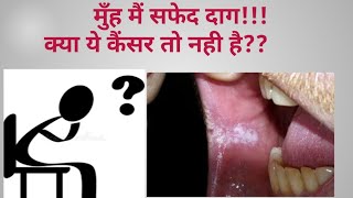 White patches in oral cavity मुह मैं सफेद दाग [upl. by Bissell]