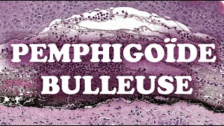 LA PEMPHIGOÏDE BULLEUSE  PATHOLOGIE [upl. by Fabiola413]