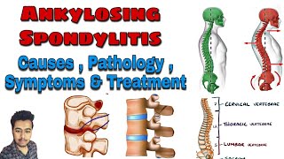 Ankylosing Spondylitis  Cause  Pathology  Symptoms  Treatment Nursing Lecture in Hindi MSN 1 [upl. by Aenad4]