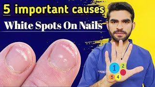 Leukonychia causes  5 important causes of white spots on nails [upl. by Louth]