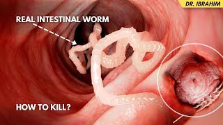 Pait Ke Keeron Ka Ilaj  Remove Intestinal Worms  Pinworms Tapeworms Hookworms  UrduHindi [upl. by Malvia693]