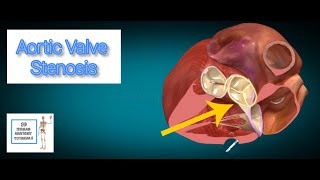 Aortic Valve Stenosis I Human Anatomy Tutorial [upl. by Nolly938]