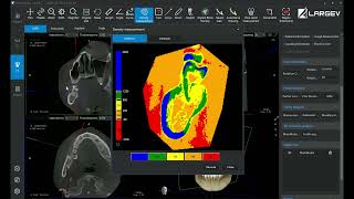 Dental Boun Density measurements from CBCT [upl. by Ralyat]