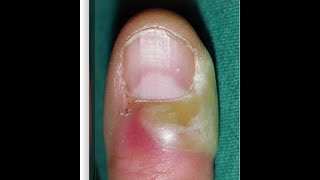 Paronychia Acute and Chronic  Easily Explained  less than 6 mins [upl. by Ezechiel]