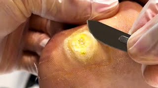 Pedicure Tutorial A Quick Fix for Plantar Warts [upl. by Boar986]