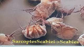 Sarcoptes scabies affecting both kids Scabies Kudis Buta 7 Year Skin Itch KL [upl. by Vergos641]