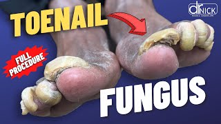 Cutting THICK fungus TOENAILS [upl. by Iseabal]