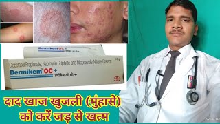 दाद खाज की बेस्ट क्रीम  treatment of ringworm  Dermikem oc creame use in hindi  Panderm plus [upl. by Luise]