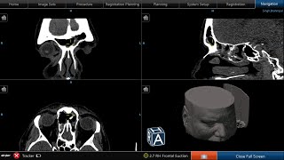 Bilateral revision endoscopic sinus surgery [upl. by Ashmead864]