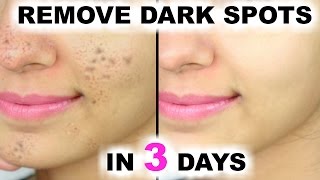 Skin Repair  Close Large OPEN PORES in 1 week Remove Dark Spots Anti Aging [upl. by Kamaria]