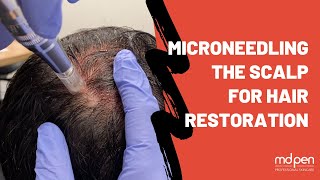 Microneedling The Scalp For Hair Restoration  MDPen [upl. by Amorita402]