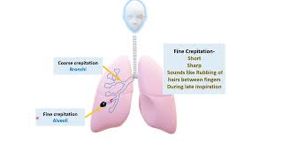 Crackles I Crepitation I Pediatrics [upl. by Kessiah]