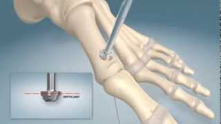 1st MTPJ arthrodesis procedure [upl. by Lamak]