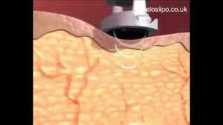 How Ultrasonic Cavitation Works [upl. by Asilaj]