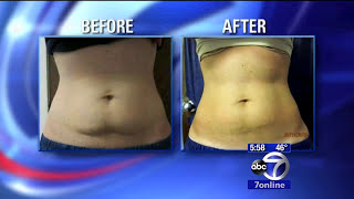 How CoolSculpting works [upl. by Ardaed]