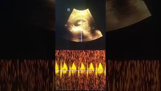 Pregnancy Ultrasound of 9 weeks 5 days Baby [upl. by Alleynad]