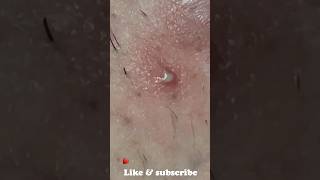 Ingrown infected removal [upl. by Friede]