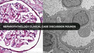 2017 03 16 Nephropathology Clinical Case Discussion Rounds [upl. by Erastatus]