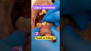 Crazy Teeth  Broken Fillings [upl. by Arakihc487]