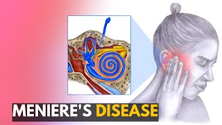 Menieres disease Everything You Need to Know [upl. by Skip197]