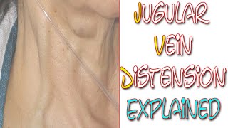 What Is Jugular Vein Distention  Something In About 5 Minutes  Medic Materials [upl. by Nyliret540]