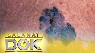 Salamat Dok Melanoma and cancerous moles [upl. by Eniarrol842]