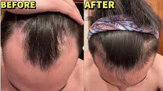 HYPERRESPONDER ON BIG 3  MICRONEEDLING HAIR LOSS STACK INSANE 5 MONTH RESULTS [upl. by Porte]