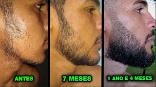 1 ANO E 4 MESES USANDO MINOXIDIL Pant Kirkland e Dom Pelo [upl. by Krucik]