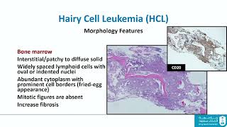 Splenic B cell lymphomaleukemia – Dr Khalid Alayed September 1516 2023 [upl. by Evy]