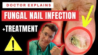 How to recognise diagnose amp treat FUNGAL NAIL INFECTION Onychomycosis  Doctor ODonovan explains [upl. by Lambrecht]