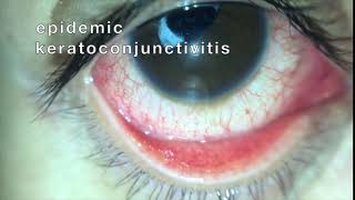 EKC epidemic keratoconjunctivitis [upl. by Tal]