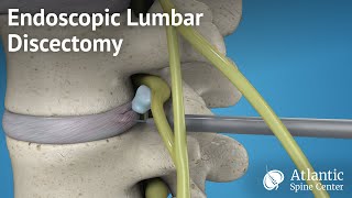 Endoscopic Lumbar Discectomy [upl. by Lachish]