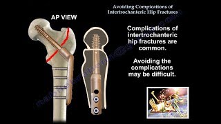 Avoiding Complications Intertroch Hip Fractures  Everything You Need To Know  Dr Nabil Ebraheim [upl. by Eyram423]