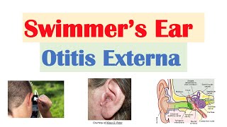 Swimmer’s Ear Otitis Externa  Risk Factors Causes Signs amp Symptoms Diagnosis Treatment [upl. by Brody659]