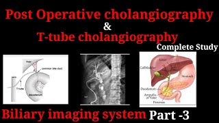 Ttube cholangiography  Post operative cholangiography  Biliary imaging system part 3 [upl. by Oironoh]