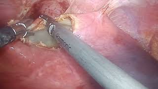 hydatid cyst surgery at Bombay hospital Indore [upl. by Nykal]