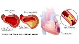 Acute Coronary Syndrome ACS شرح بالعربى متلازمة الشريان التاجي الحادة [upl. by Adrianna]