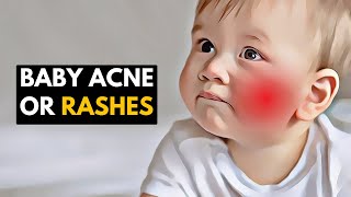 Gentle Care for Little Faces Managing Baby Acne and Rashes [upl. by Hsevahb]