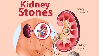 what are causes of kidney stones   Dr JANANI [upl. by Ynaitirb711]