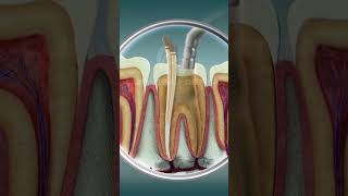 Root Canal Treatment  Curveia Dental I RCT [upl. by Britni]