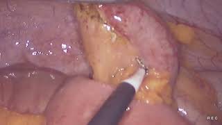 Laparoscopic appendectomy unedited 882024 [upl. by Attenrad]