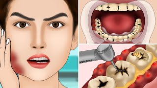 ASMR Molar Tooth Caries Removal so Satisfying part3  Dental Care Animation  어금니 우식증 제거 너무 만족 [upl. by Ylicic309]